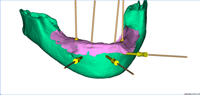 stackable-Fall mit Dr. Jan Spieckermann