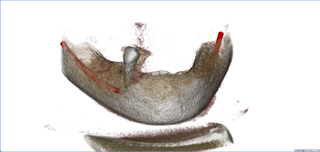 stackable-Fall mit Dr. Jan Spieckermann