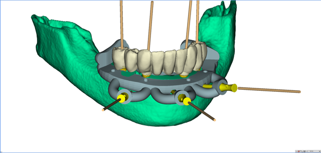 stackable-Fall mit Dr. Jan Spieckermann