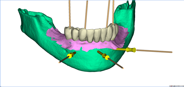 stackable-Fall mit Dr. Jan Spieckermann