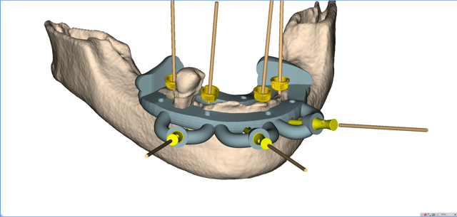 stackable-Fall mit Dr. Jan Spieckermann