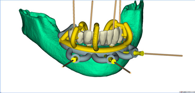 stackable-Fall mit Dr. Jan Spieckermann